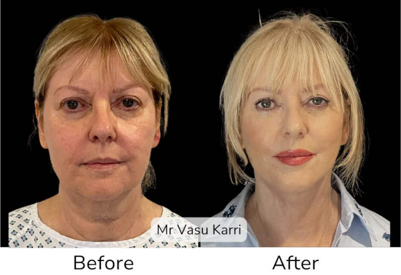 Facelift Patient 11 View 1
